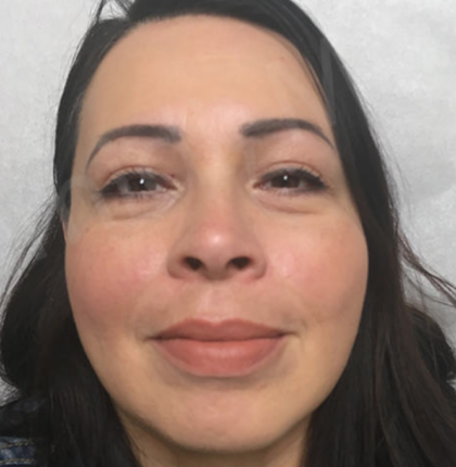 Blepharoplasty Before & After Patient #9006