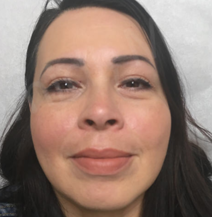 Blepharoplasty (Eyelid Surgery) Before & After Patient #9006