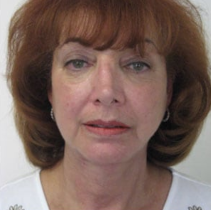 Facelift and Necklift Before & After Patient #9017
