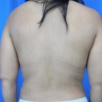 Liposuction Before & After Patient #7952