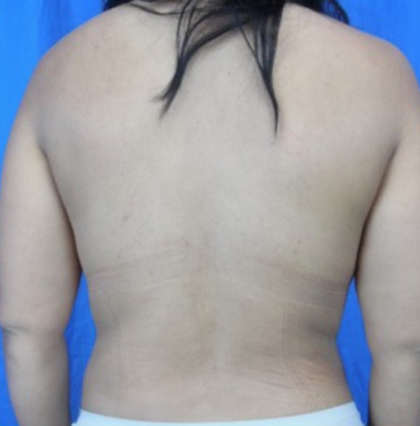Liposuction Before & After Patient #7952