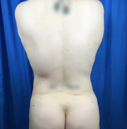 Liposuction Before & After Patient #7955