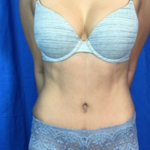 Liposuction Before & After Patient #7965