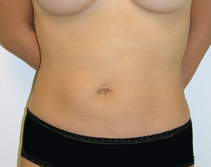 Liposuction Before & After Patient #8066