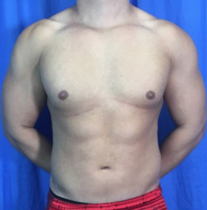 Liposuction Before & After Patient #9083