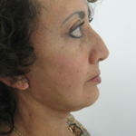 Facelift and Necklift Before & After Patient #7811