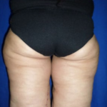 Thigh Lift Before & After Patient #8098