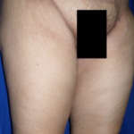 Thigh Lift Before & After Patient #8105