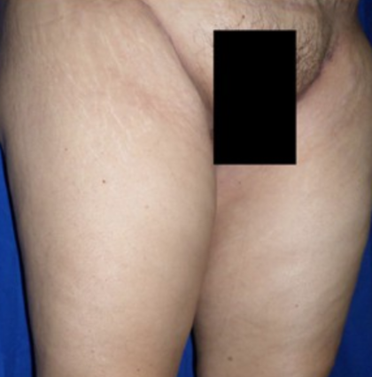 Thigh Lift Before & After Patient #8105