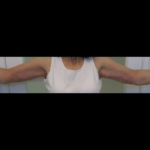 Arm Lift Before & After Patient #7222