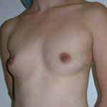 Breast Augmentation Before & After Patient #8845