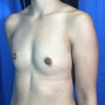 Breast Augmentation Before & After Patient #8881