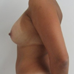 Breast Augmentation Before & After Patient #8902