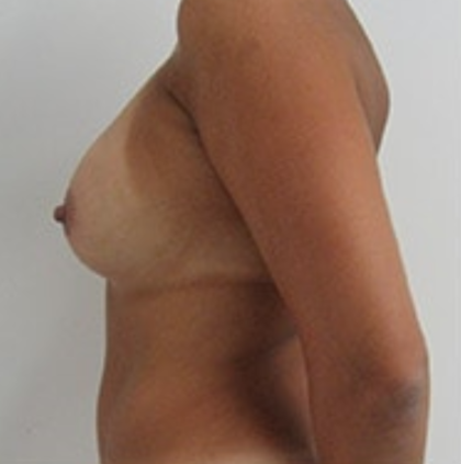 Breast Augmentation Before & After Patient #8902