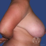 Breast Lift / Mannequin Breast Lift Before & After Patient #8929