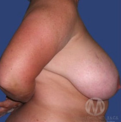 Breast Lift / Mannequin Breast Lift Before & After Patient #8929