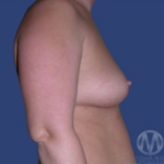 Breast Lift / Mannequin Breast Lift Before & After Patient #8934