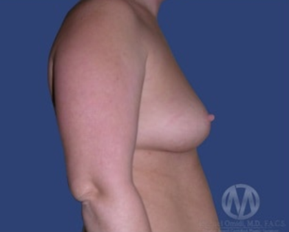 Breast Lift / Mannequin Breast Lift Before & After Patient #8934