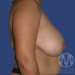 Breast Lift / Mannequin Breast Lift Before & After Patient #8949