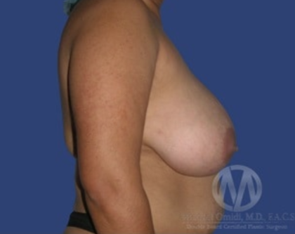 Breast Lift / Mannequin Breast Lift Before & After Patient #8949