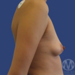 Breast Lift / Mannequin Breast Lift Before & After Patient #8960