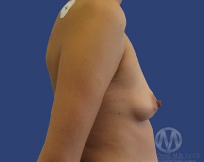 Breast Lift / Mannequin Breast Lift Before & After Patient #8960