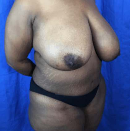 Breast Lift / Mannequin Breast Lift Before & After Patient #8959