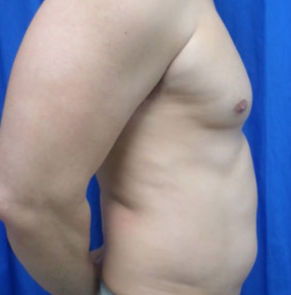 Liposuction Before & After Patient #7926