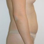 Liposuction Before & After Patient #8066