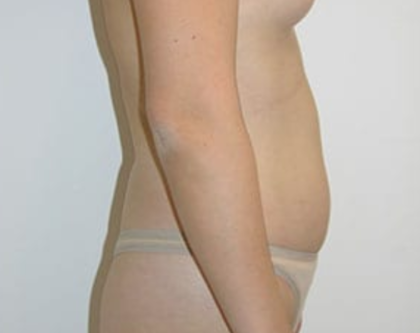 Liposuction Before & After Patient #8066