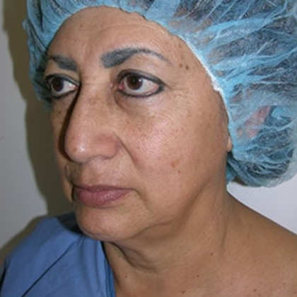 Facelift and Necklift Before & After Patient #7811