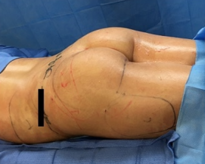 Brazilian Butt Lift Before & After Patient #8802