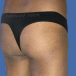 Brazilian Butt Lift Before & After Patient #8809