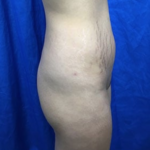 Brazilian Butt Lift Before & After Patient #8821