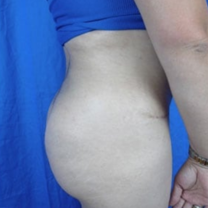 Brazilian Butt Lift Before & After Patient #7275