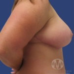 Breast Lift / Mannequin Breast Lift Before & After Patient #8929