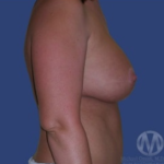 Breast Lift / Mannequin Breast Lift Before & After Patient #8934