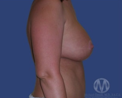 Breast Lift / Mannequin Breast Lift Before & After Patient #8934