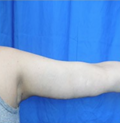 Arm Lift Before & After Patient #7201