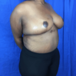 Breast Lift / Mannequin Breast Lift Before & After Patient #8959