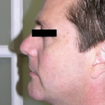 Chin Augmentation Before & After Patient #8975