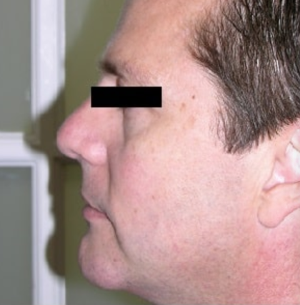 Chin Augmentation Before & After Patient #8975