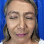 Blepharoplasty (Eyelid Surgery) Before & After Patient #9001