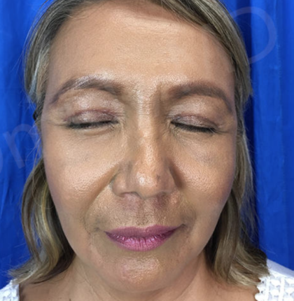 Blepharoplasty (Eyelid Surgery) Before & After Patient #9001