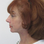 Facelift and Necklift Before & After Patient #9017