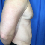 Liposuction Before & After Patient #7926