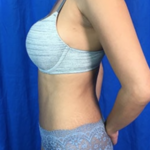 Liposuction Before & After Patient #7965