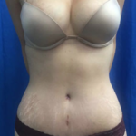 Liposuction Before & After Patient #7983