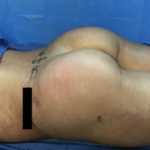 Brazilian Butt Lift Before & After Patient #8802