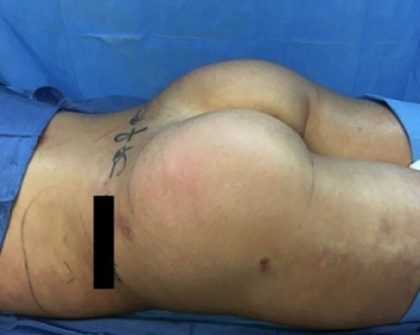 Brazilian Butt Lift Before & After Patient #8802